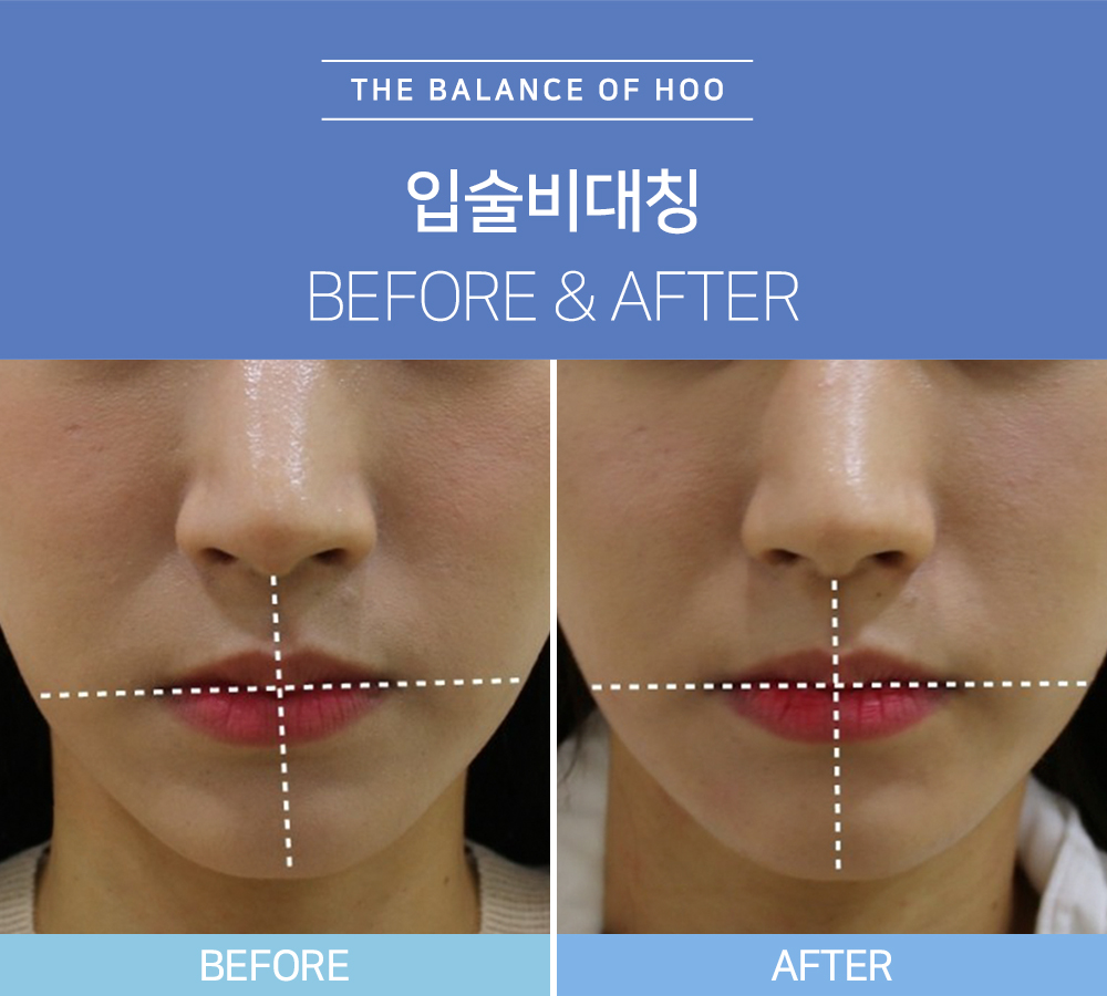 일산안면비대칭교정방법