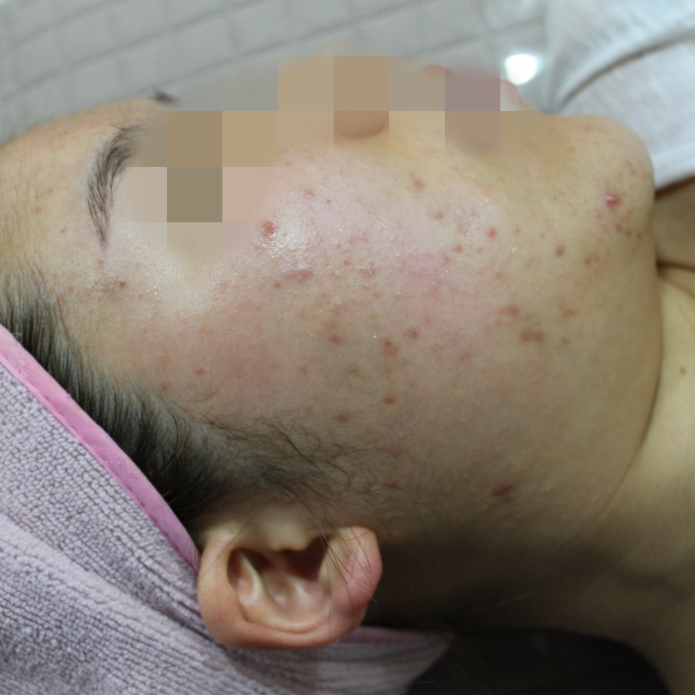 일산여드름압출 치료 전 지저분한 피부