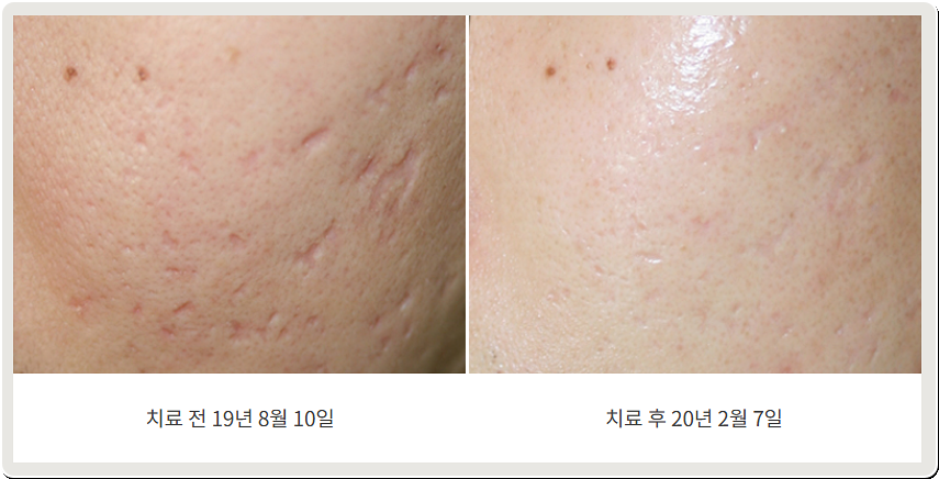 일산여드름흉터 볼 부위 흉터 치료 전후 비교 사진