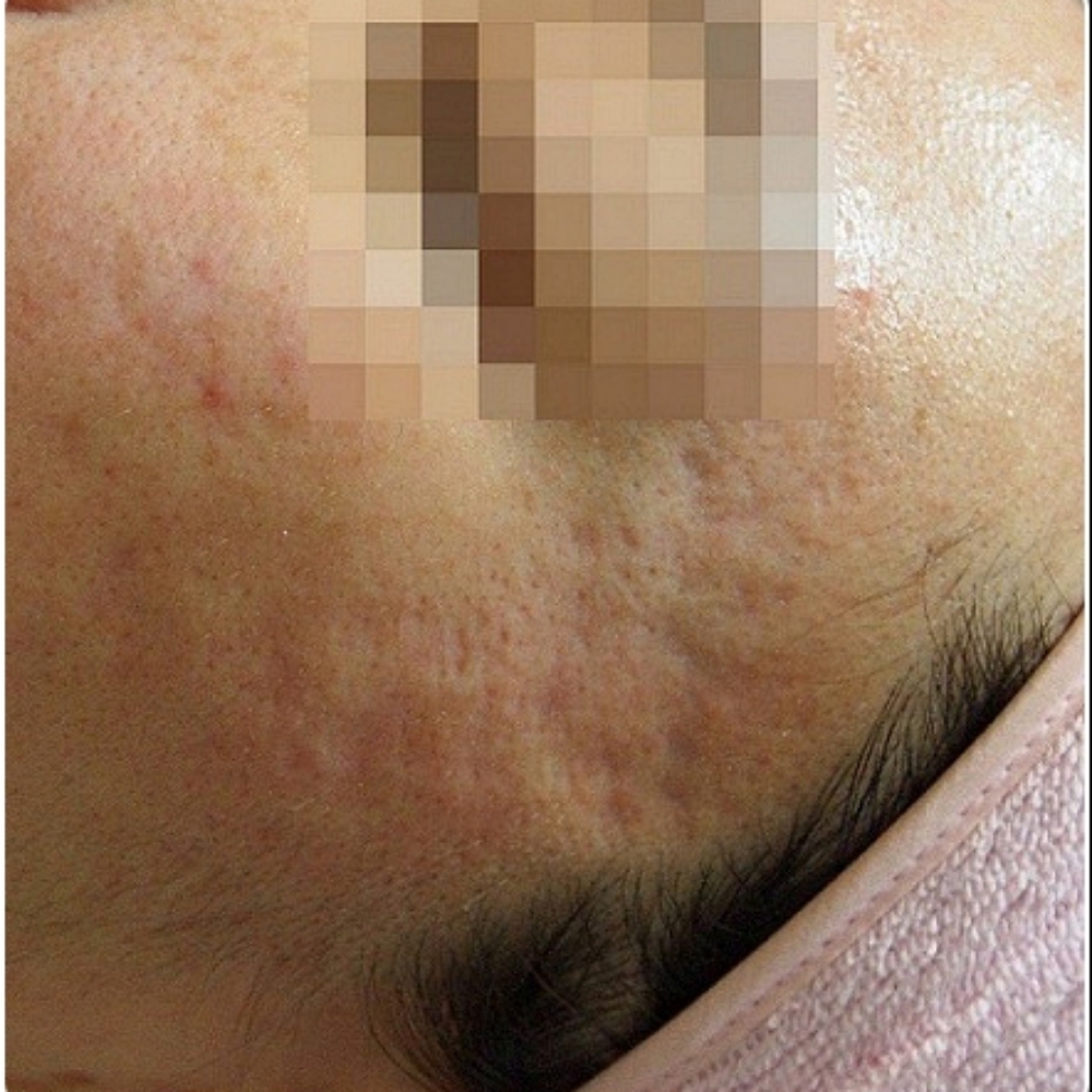 일산여드름흉터 관자놀이 부위 흉터 치료 전 피부 상태 클로즈업 사진