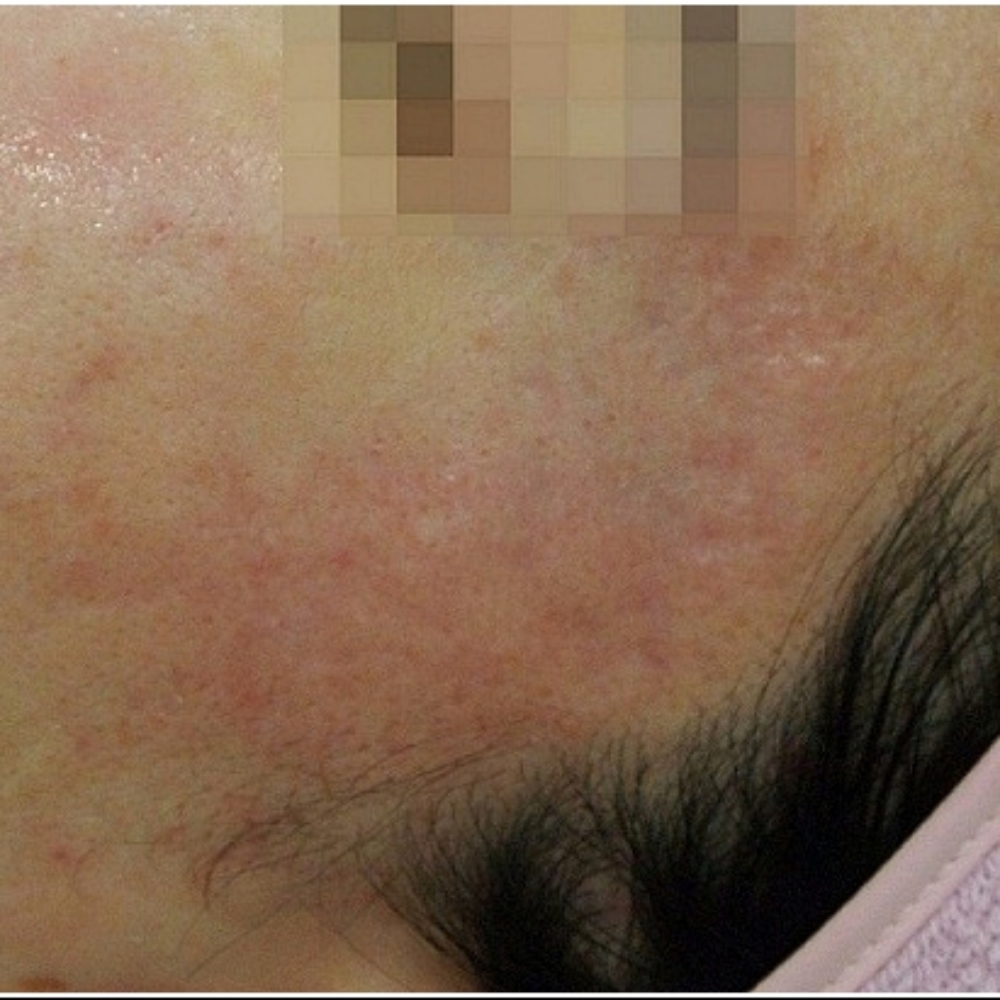 일산여드름흉터 관자놀이 흉터 치료 후