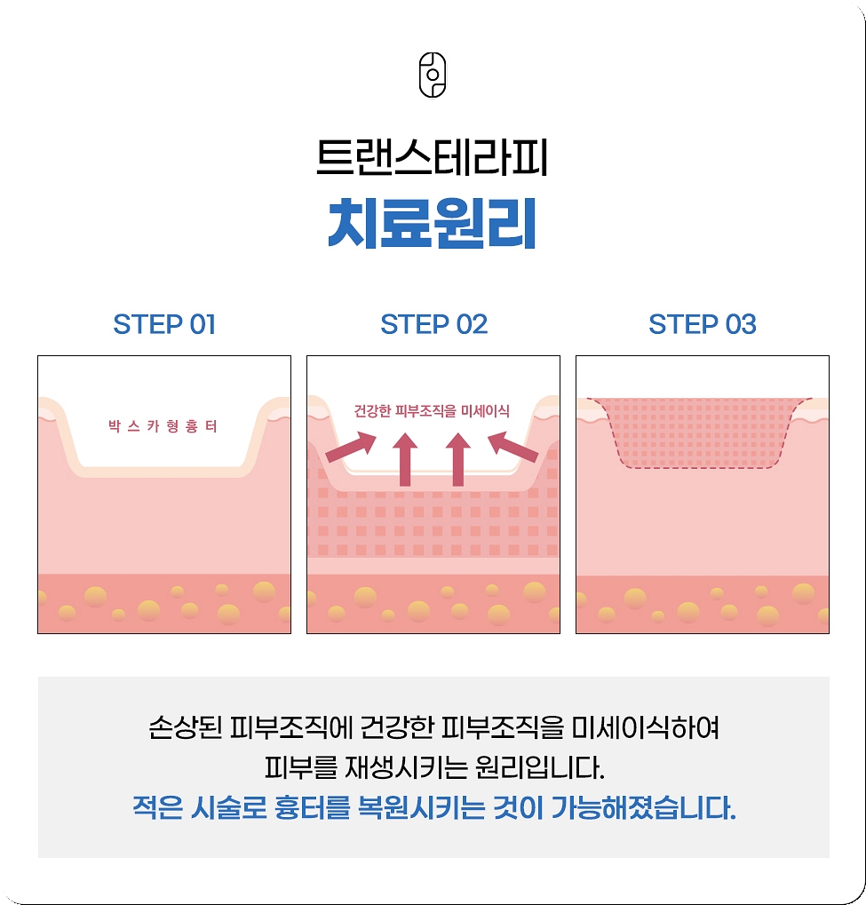 일산여드름흉터 트랜스테라피 치료 원리 3단계 설명 인포그래픽