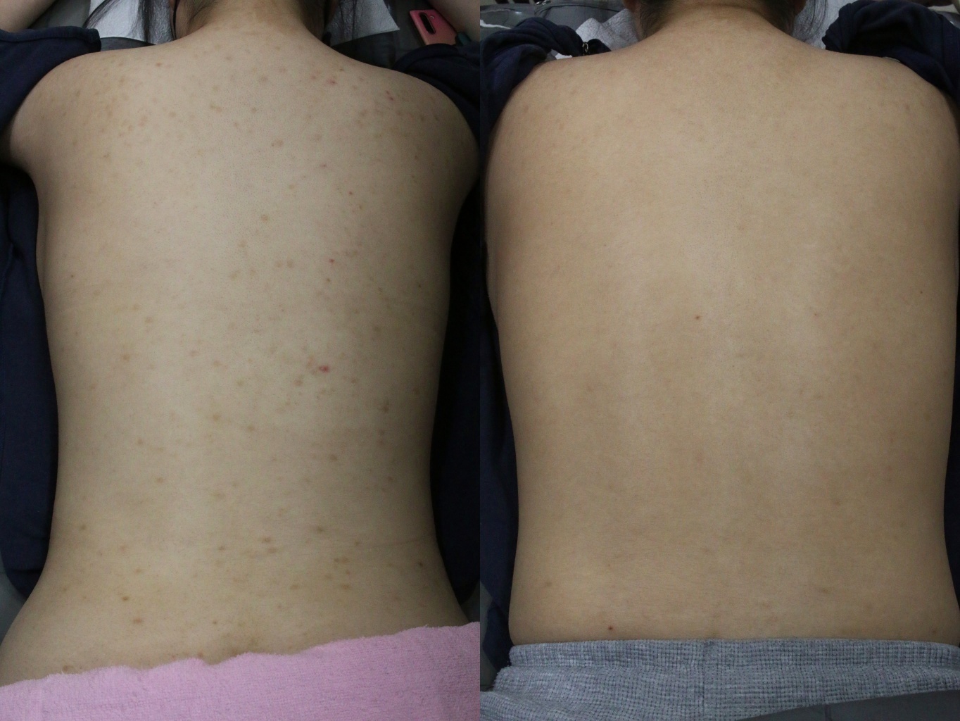 일산등드름 치료 전후 비교, 등 전체 트러블 자국이 옅어진 모습