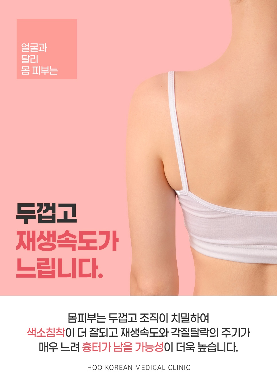 몸 피부 두껍고 재생속도 느려 흉터 위험 높은 가슴여드름