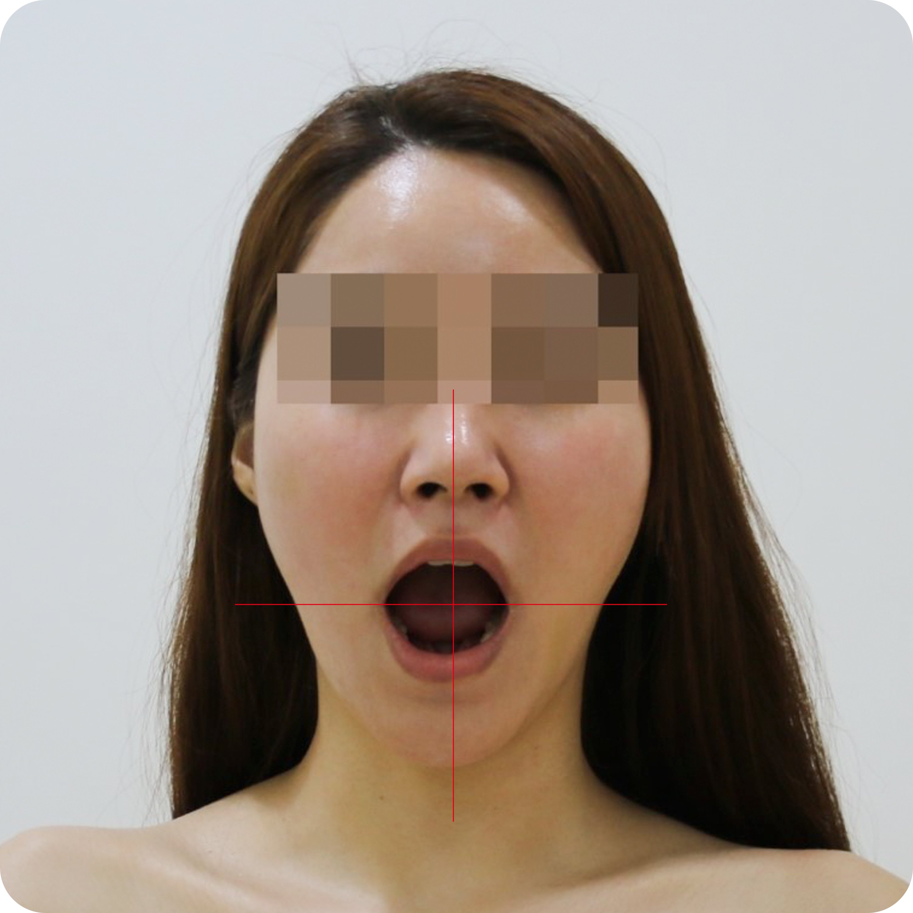 일산턱관절한의원 교정 후 