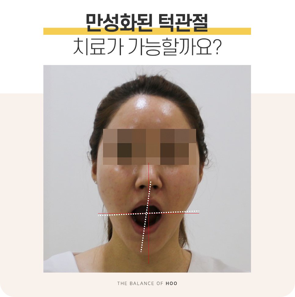 일산턱관절한의원 턱관절이 틀어진 상태