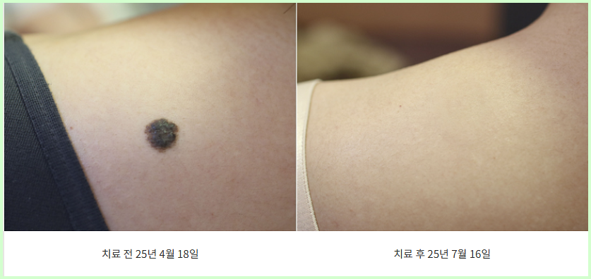 일산점제거 목 부분 큰점 제거 전후 이미지