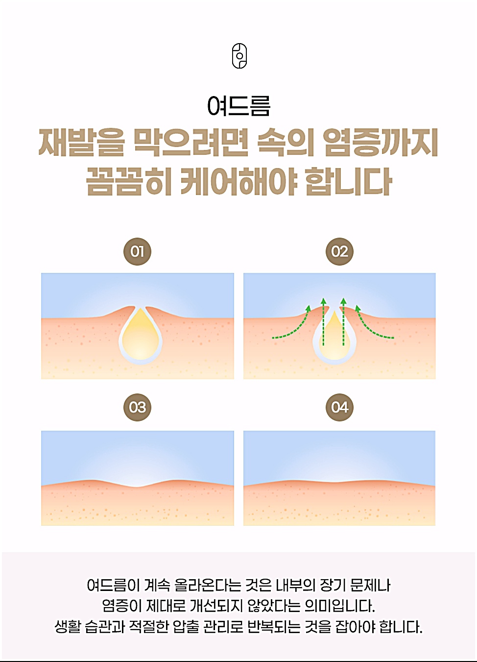 여드름 재발을 막기 위한 속염증 케어 단계를 보여주는 피부 구조 설명