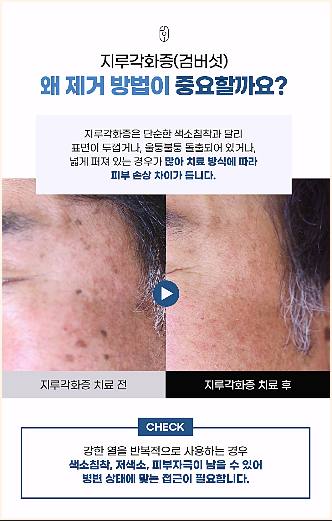 지루각화증 제거 방법에 따른 피부 손상 차이를 보여주는 전후 비교