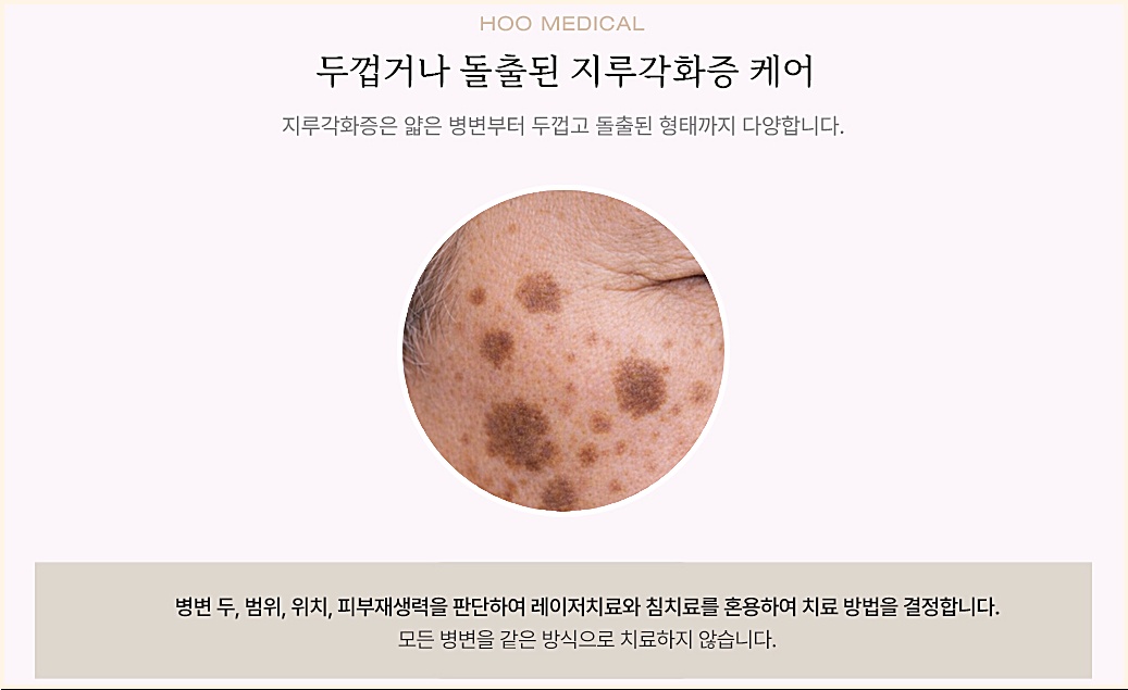 두껍거나 돌출된 지루각화증 병변 케어에 대한 설명