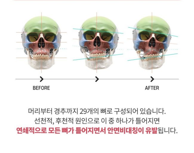 일산안면비대칭교정 방법 - 얼굴 뼈의 연쇄 틀어짐으로 생기는 안면비대칭 설명