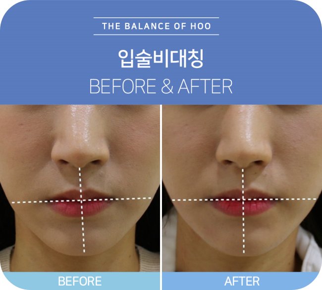 일산 후한의원 입술비대칭 교정 치료 전후 비교