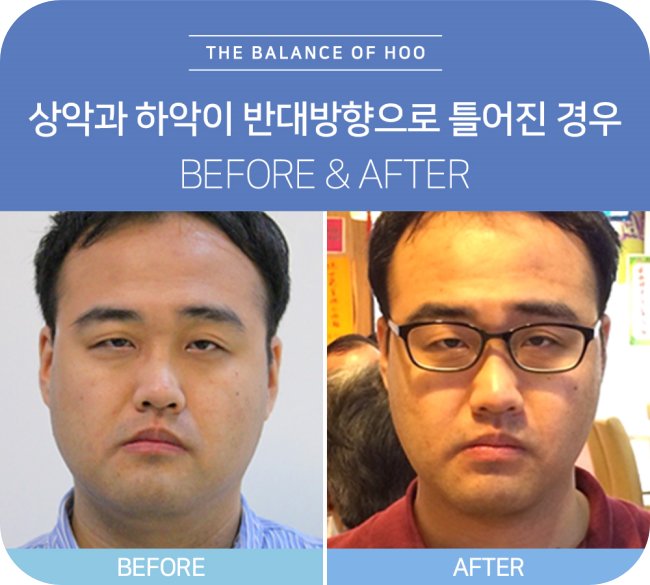 위턱과 아래턱이 반대 방향으로 틀어진 안면비대칭 교정 치료 전후 비교