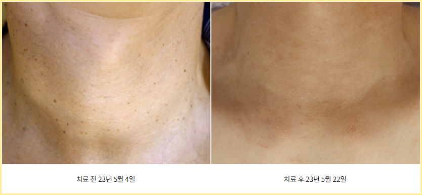편평사마귀치료 전후