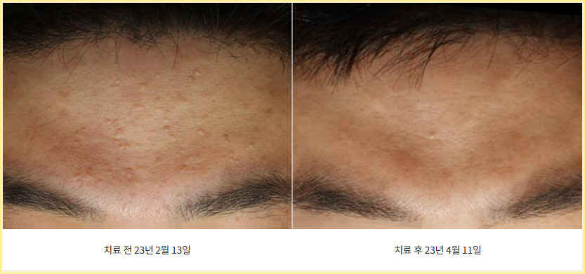 이마에 올라온 편평사마귀 사진 치료 전후