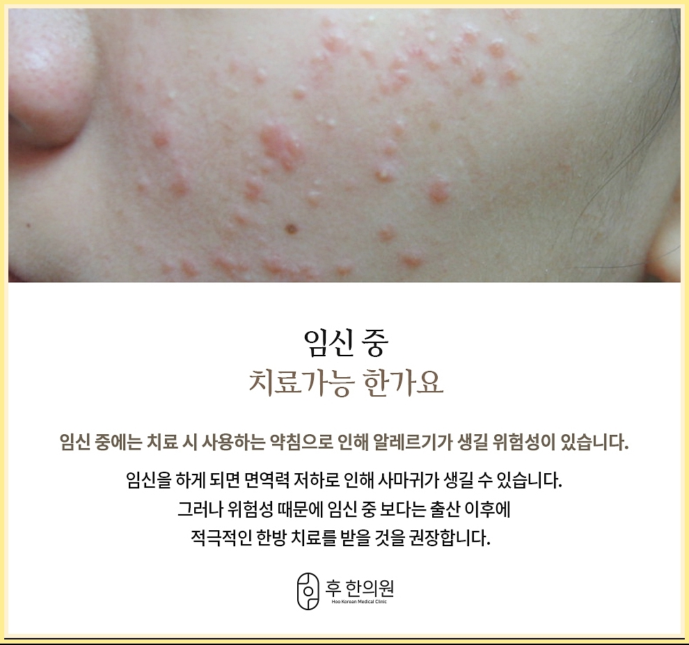 임신중 편평사마귀 치료 가능 유무