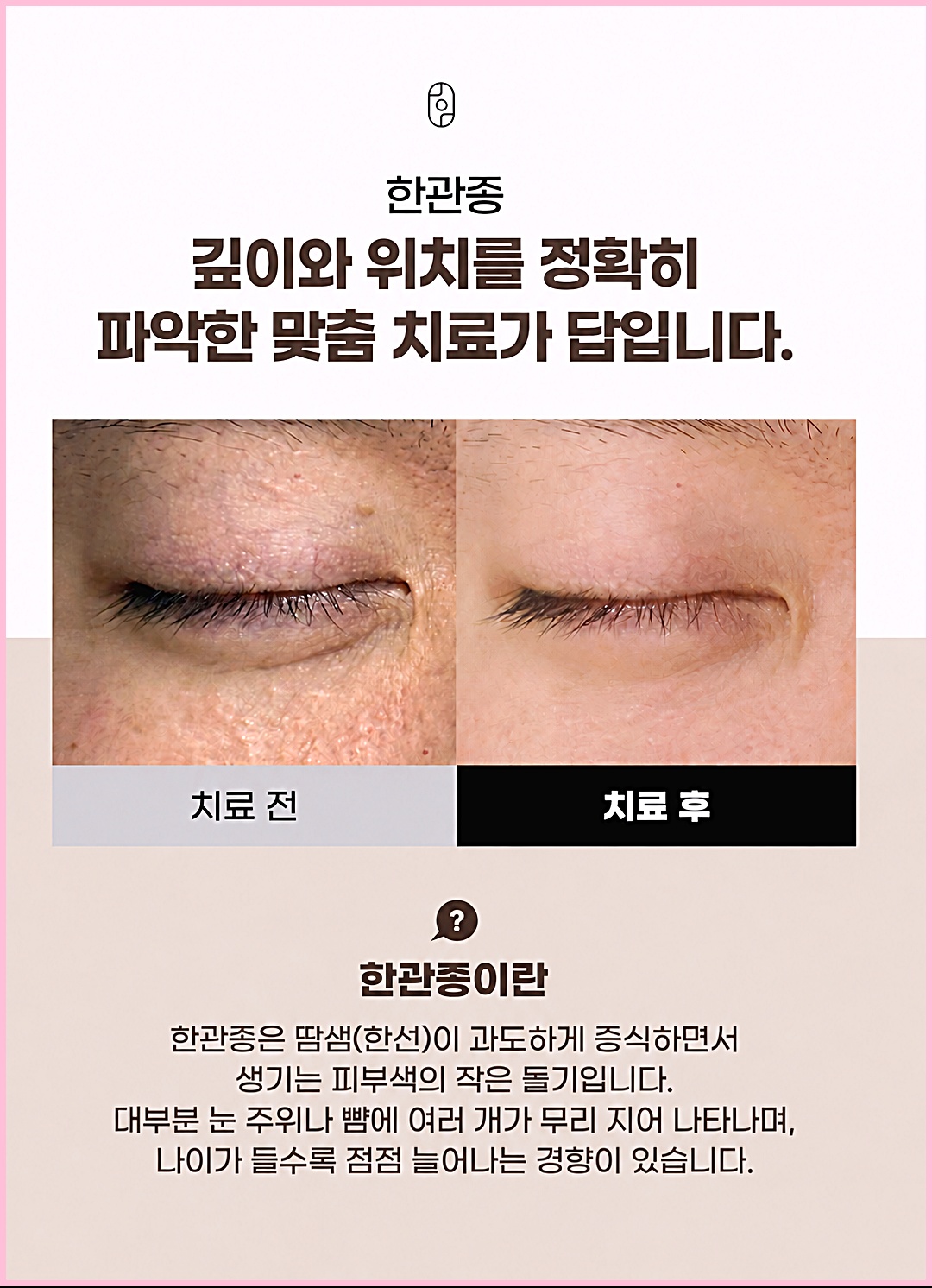 일산한관종 치료 전후 비교 사진 - 눈가 돌기 개선 모습