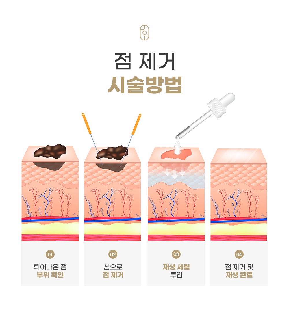 침을 활용한 단계별 점 제거 및 재생 세럼 투입 시술 원리
