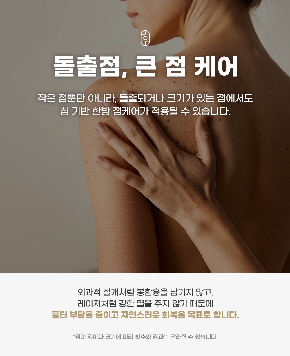 침 기반 한방 케어를 통한 돌출점 및 큰 점 치료 안내