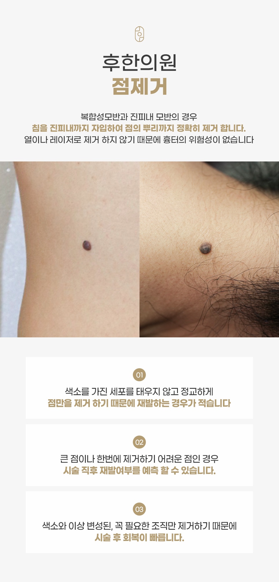 후한의원 침 기반 복합성 모반 및 진피내 모반 점제거 전후 케어