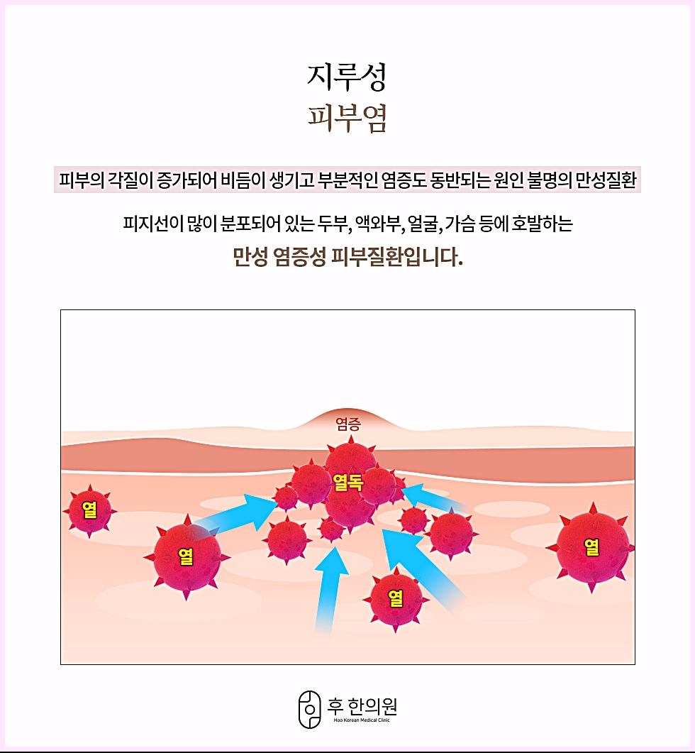 만성 염증성 피부질환인 지루성피부염의 특징과 열독 개념을 설명