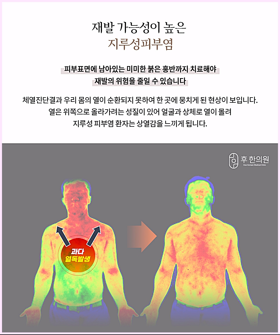 얼굴과 상체로 열이 몰리는 상열감과 열화상 변화를 나타낸 지루성피부염 설명 이미지