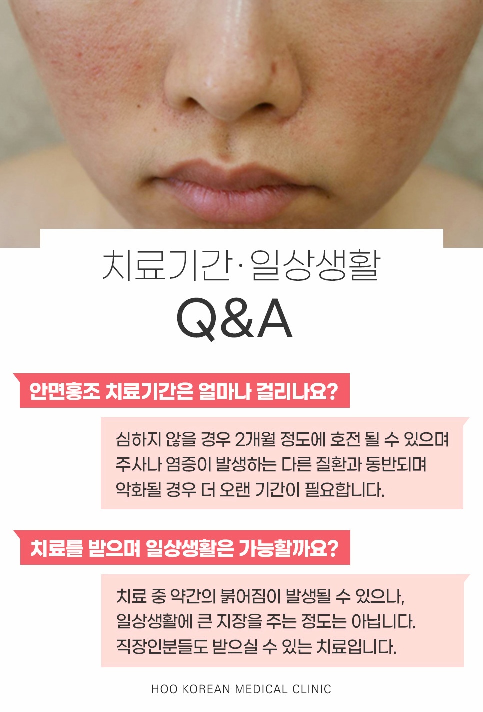 치료기간은 얼마나 걸리는지, 일상생활이 가능한지 묻고 답하는 안면홍조 Q&A