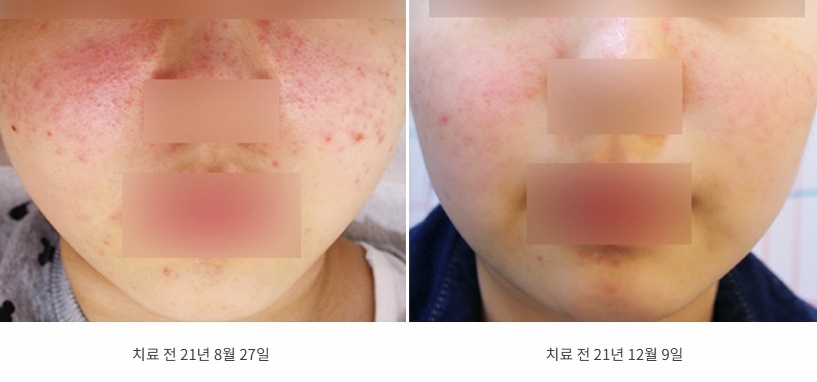 21년 8월 27일 치료 전 붉은 볼이 12월 9일 치료 후 차분해진 안면홍조 전후 비교