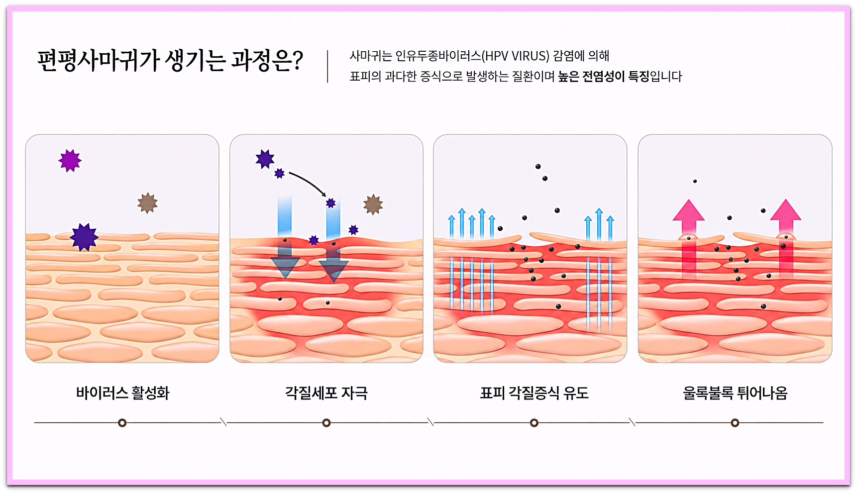 일산편평사마귀 제거 바이러스 활성화에서 울룩불룩 튀어나온 부분