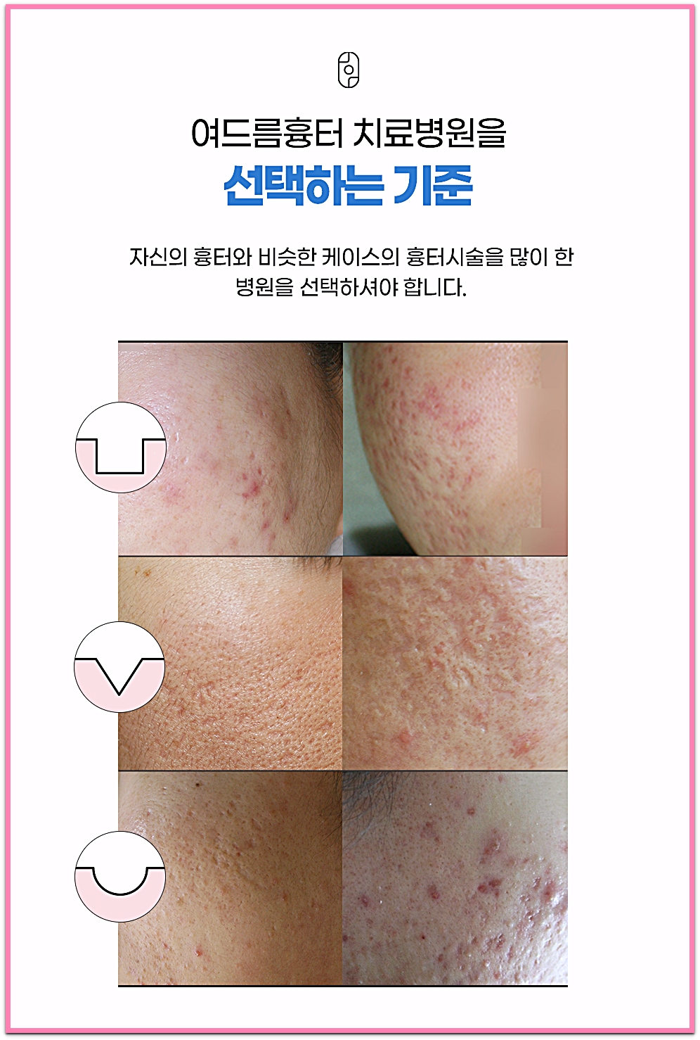 아이스픽형·박스카형·롤링형 여드름흉터 유형을 비교한 일산여드름흉터 치료 병원