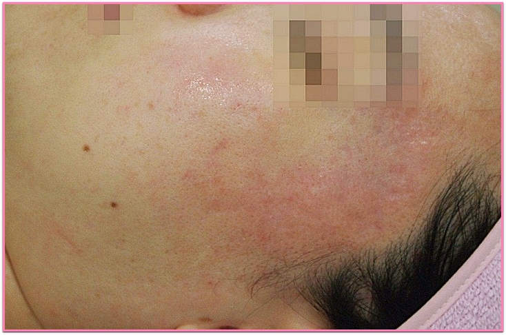 일산여드름흉터 트랜스테라피 1회 시술 후 1개월 반 경과한 볼 부위 피부 모습