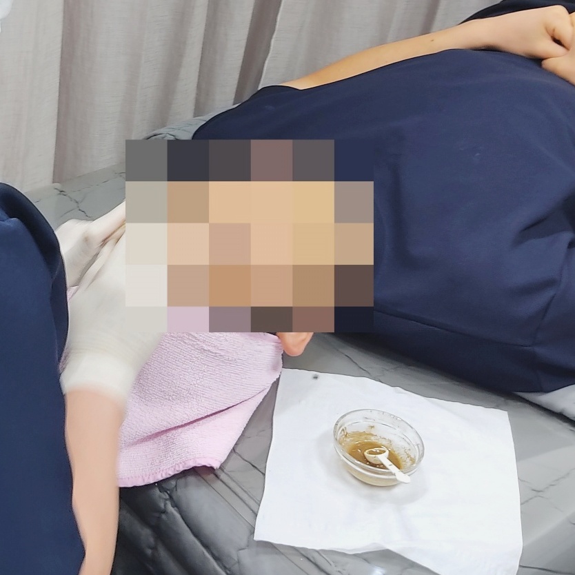 유리 용기에 담긴 약초 필링제를 장갑 낀 손으로 얼굴에 바르는 시술 준비 장면