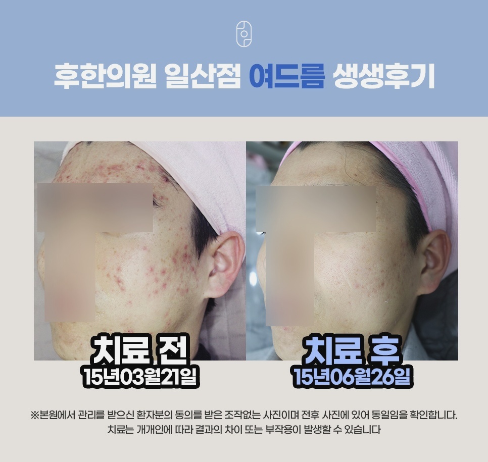 여드름 치료 전후 두 번째 사례