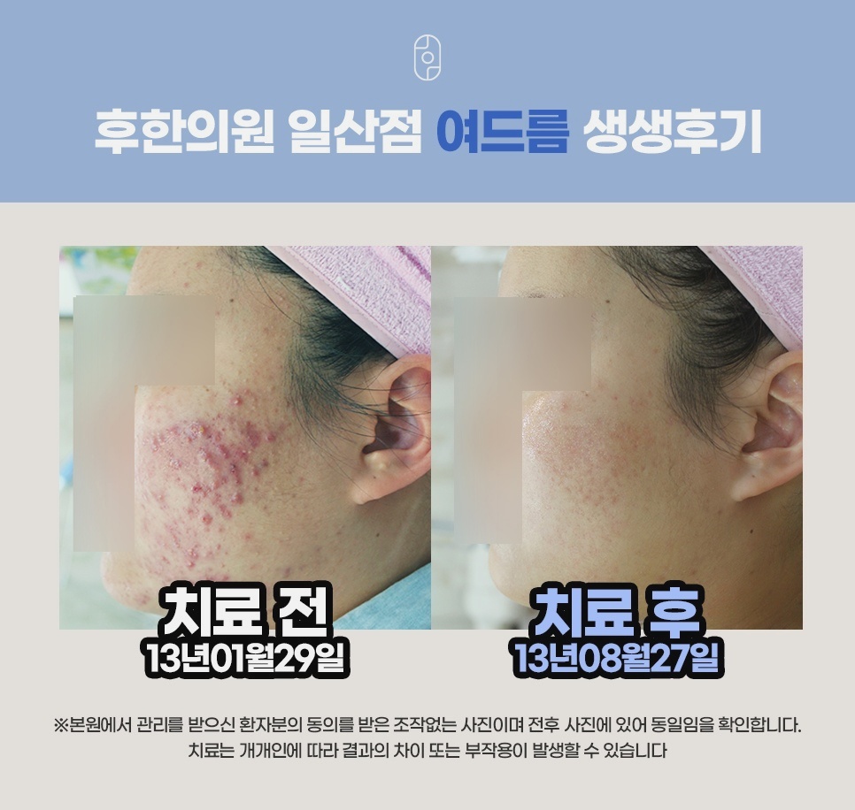 여드름 치료 전후